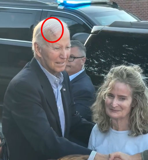 “바이든 전 대통령, 이마에 큰 상처 포착…피부암 제거 수술 후 회복 중”