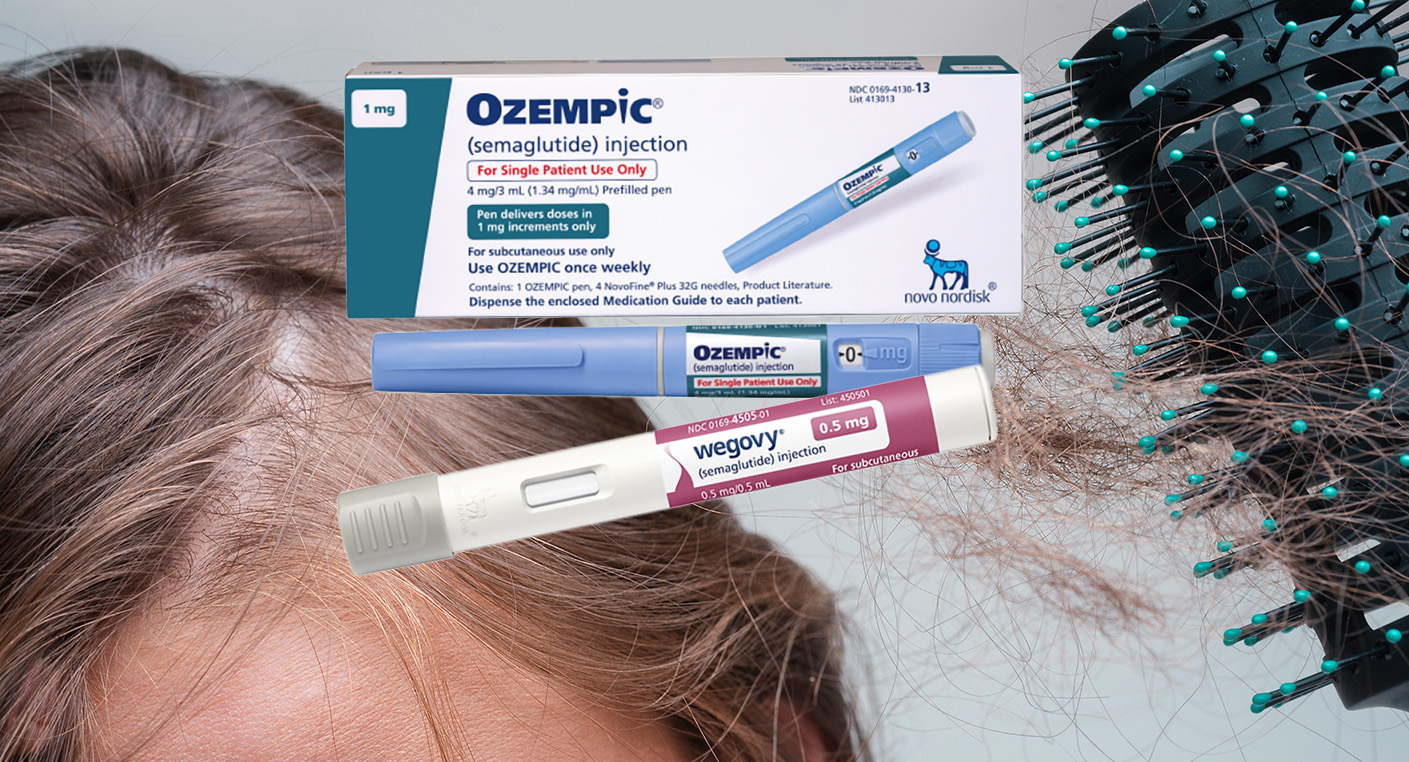 위고비·오젬픽, 살도 빠지고 머리도 빠진다?